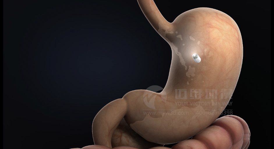 醫(yī)學醫(yī)療三維動畫 醫(yī)學醫(yī)療三維動畫