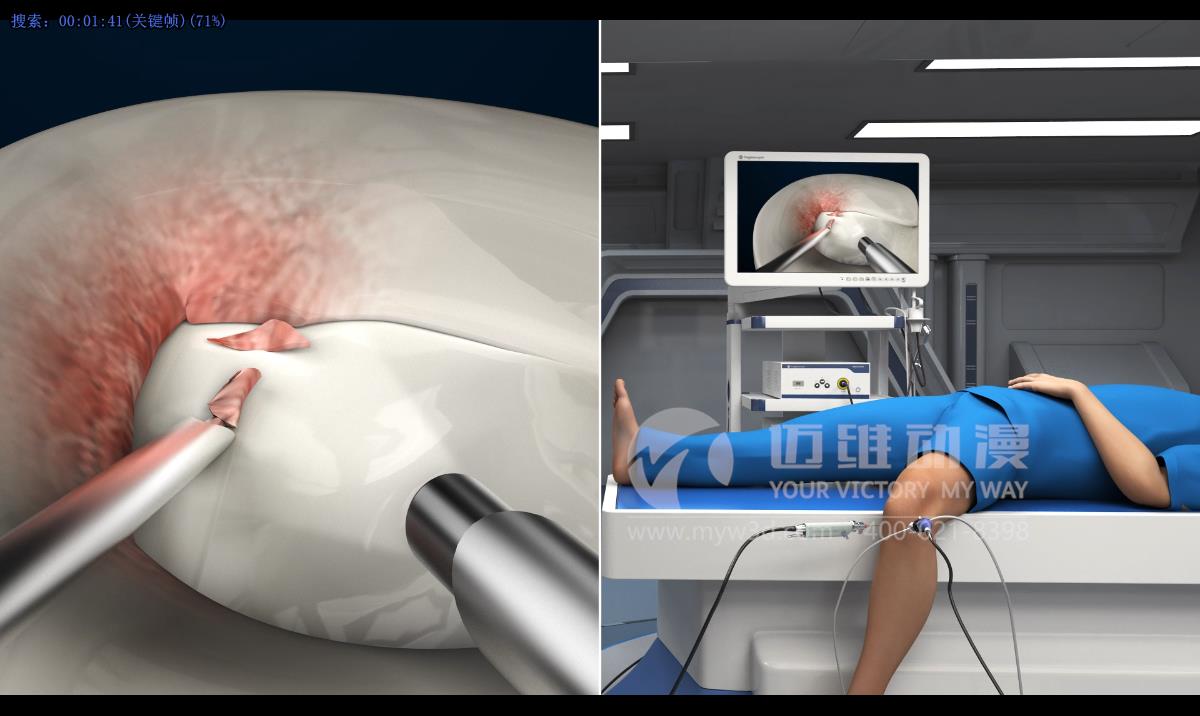 人體手術三維動畫.jpg 人體手術三維動畫.jpg