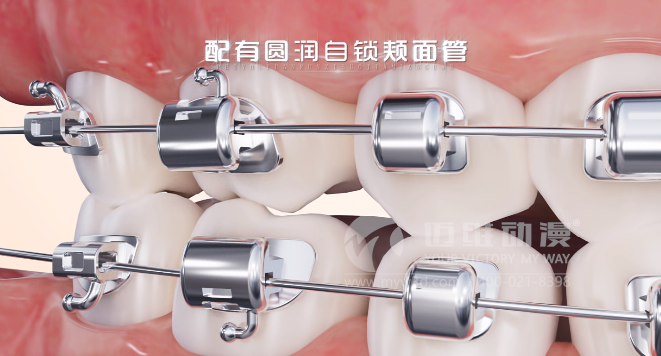 華文7D自鎖托槽產(chǎn)品展示三維動(dòng)畫(圖1) 華文7D自鎖托槽產(chǎn)品展示三維動(dòng)畫(圖1)